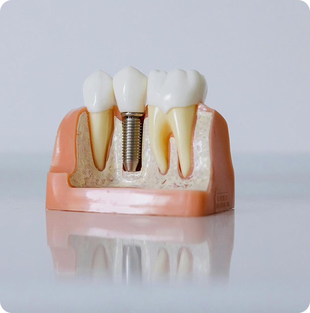 Advanced Dental Implants Treatment Model