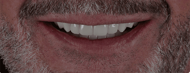 Teeth After Dental Treatment