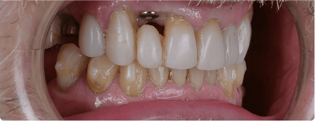 Teeth Before Dental Treatment