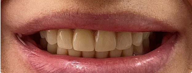 Dental Implants After
