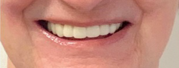 Dental Implants After