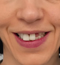 Dental Implants After