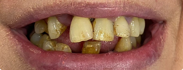 Dental Implants Before
