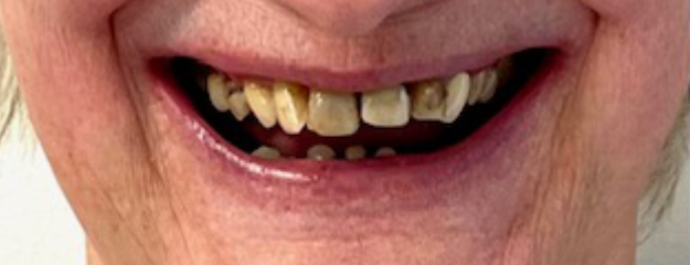Dental Implants Before