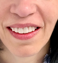 Dental Implants Before