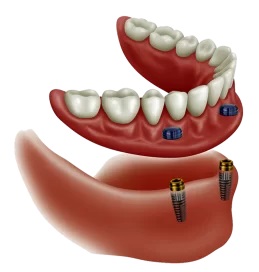 Dental Implant treatments Poole Andover Whitchurch Hampshire