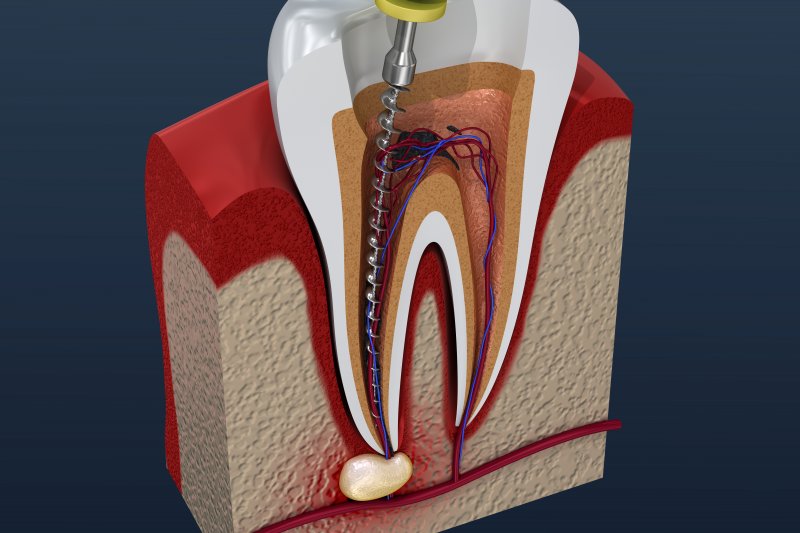 Root Canal treatment Whitchurch Hampshire