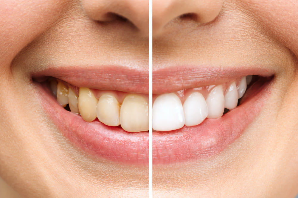 Teeth Whitening image