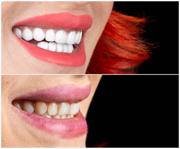 Crafting the Perfect Smile: How Veneers Fit Your Face with Precision