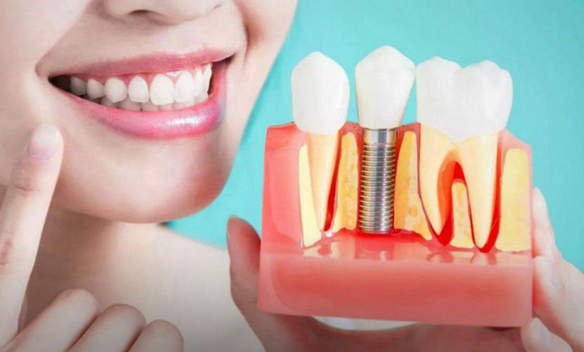 Restore Your Smile with Dental Implants– Trusted Dentist in Bandra, Mumbai