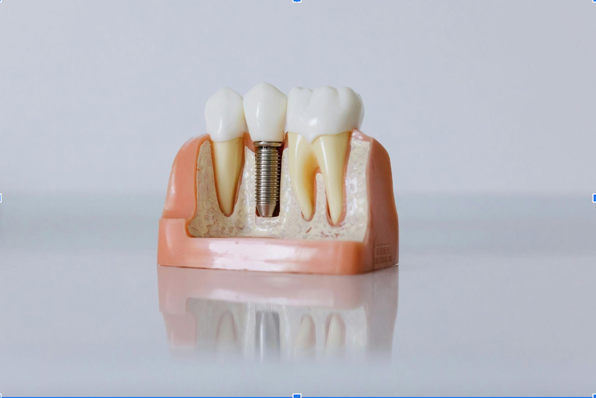 What to Eat After Getting Dental Implants: A Recovery Guide