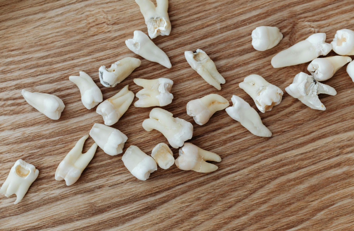 What to Do If You Break a Tooth: Immediate Steps to Take