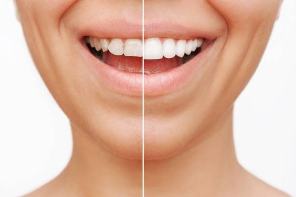 Unveiling the Truth Behind Veneer Breath: Causes, Solutions, and Prevention