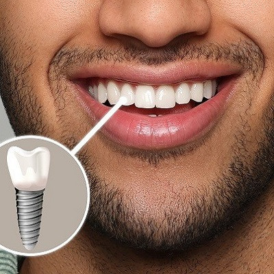 Restore Your Smile and Confidence with Dental Implants 