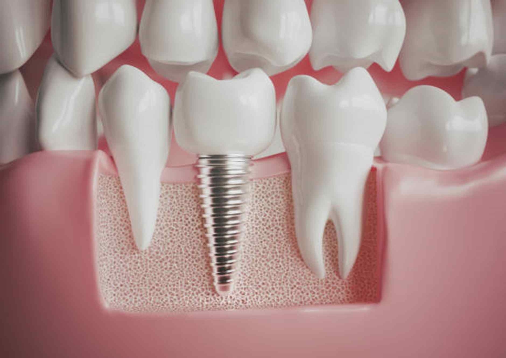 Your Frequently Asked Questions About Dental Implants