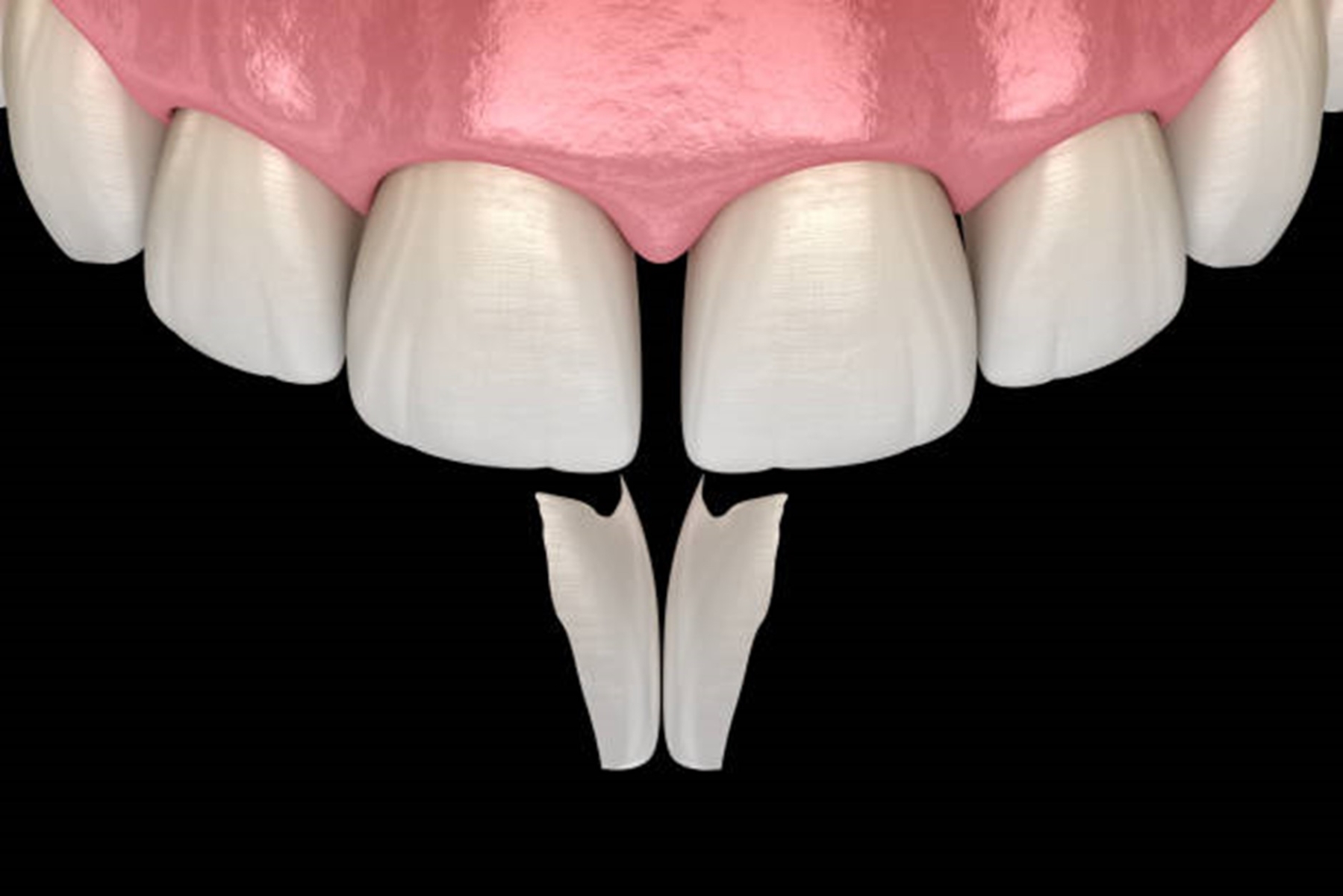 The Benefits and Drawbacks of Dental Bonding (Composite Bonding)