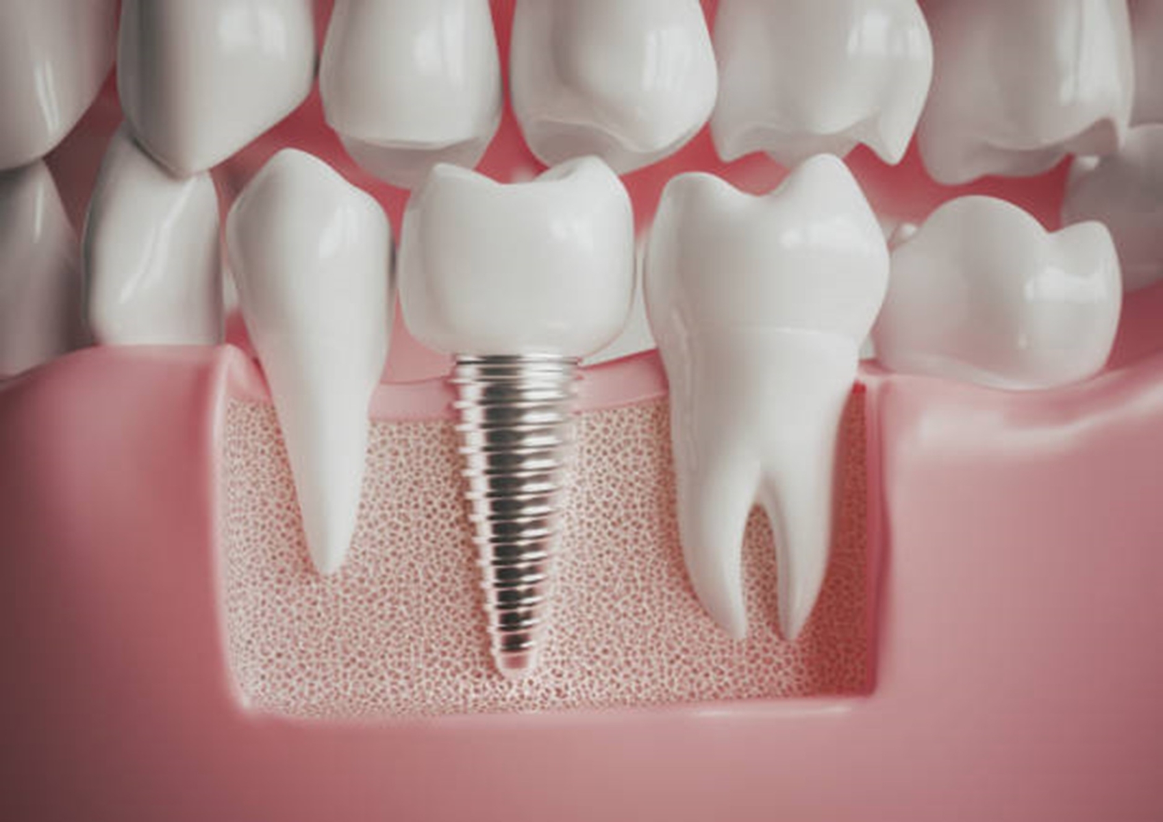 Why Dental Concepts Lead the Way when it comes to Dental Implants
