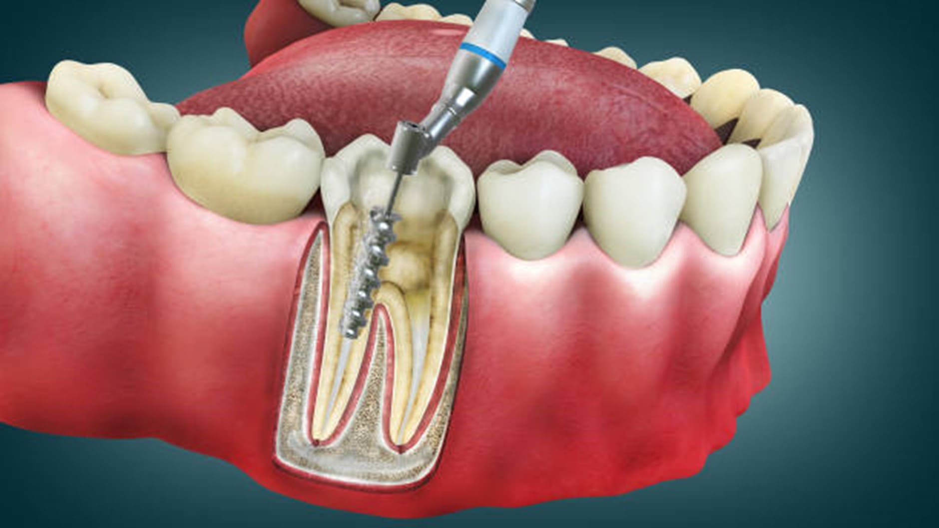 Demystifying Root Canal Treatment: Your FAQs Answered