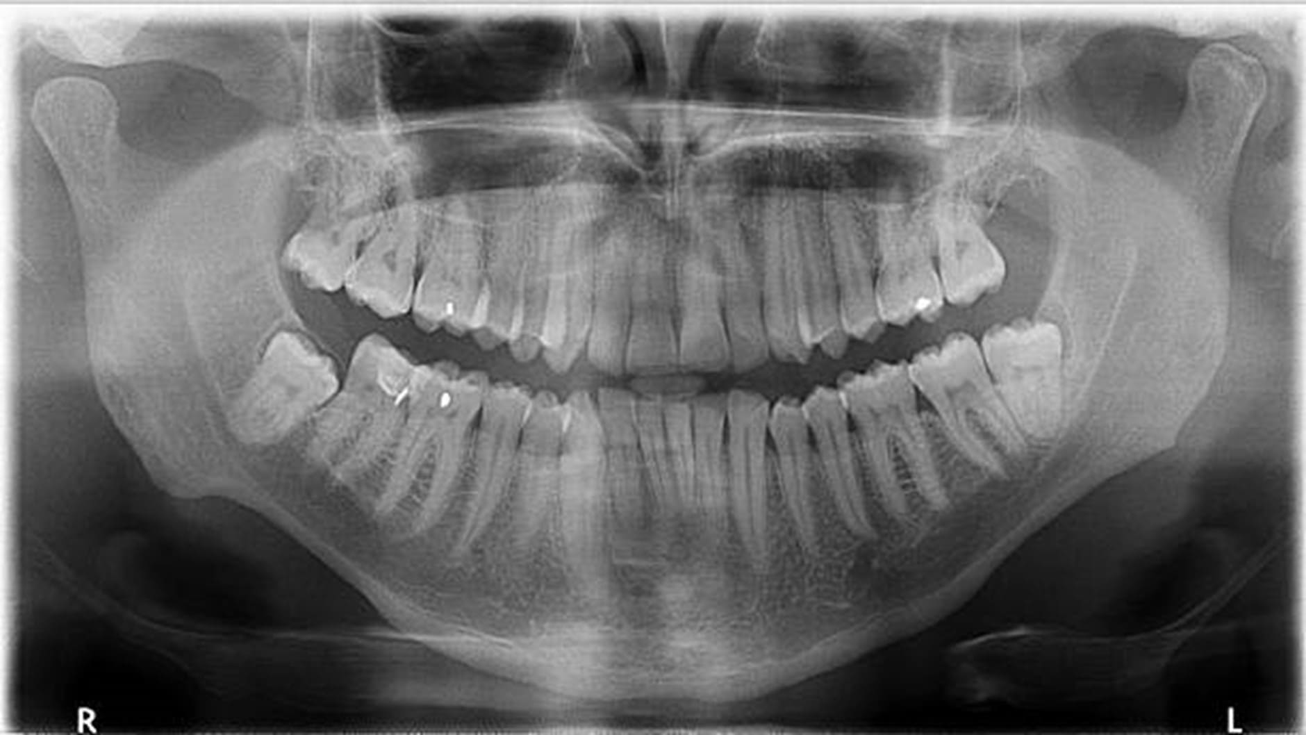 Demystifying Dental X-Rays