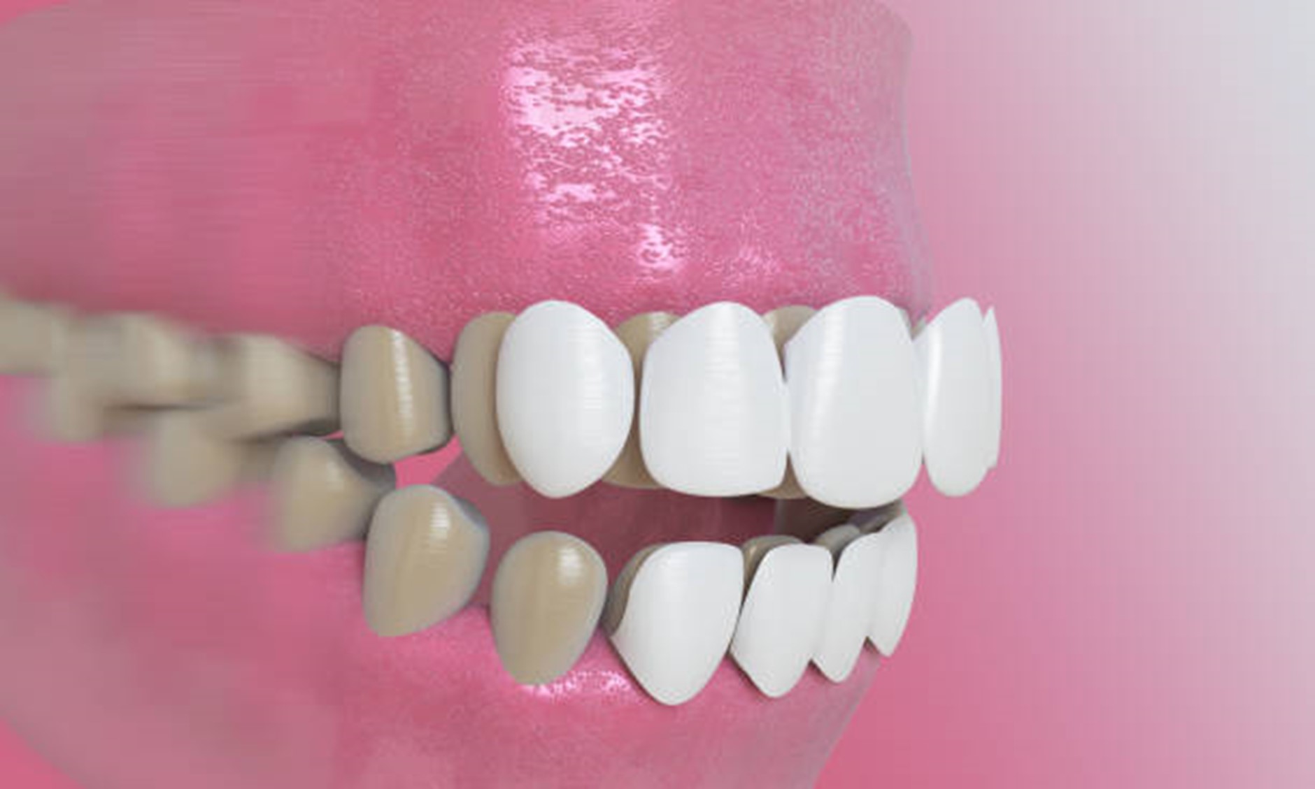 The Art of Natural-Looking Veneers: How Dental Concepts Nails It