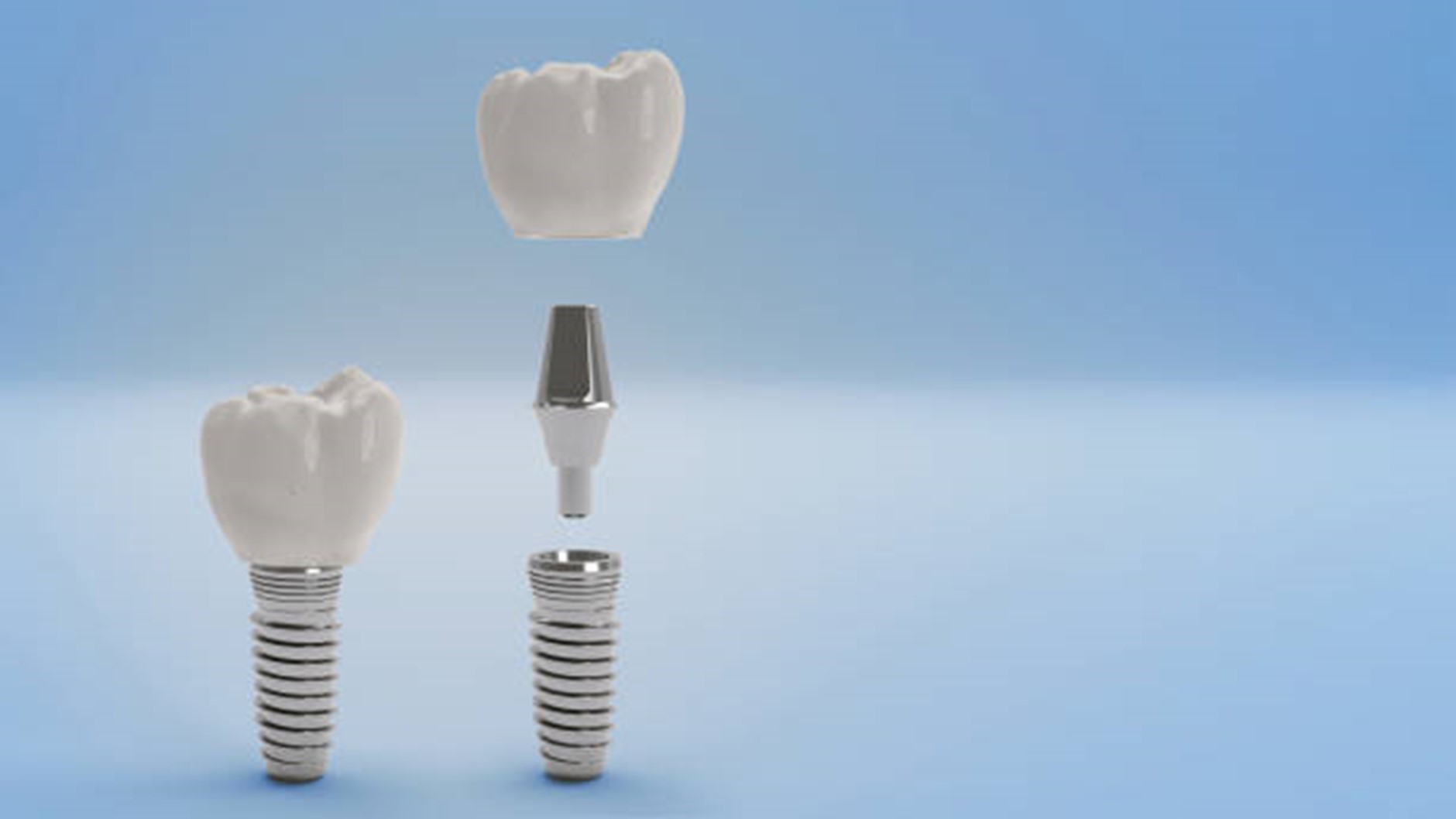 10 Lesser-Known Facts About Dental Implants