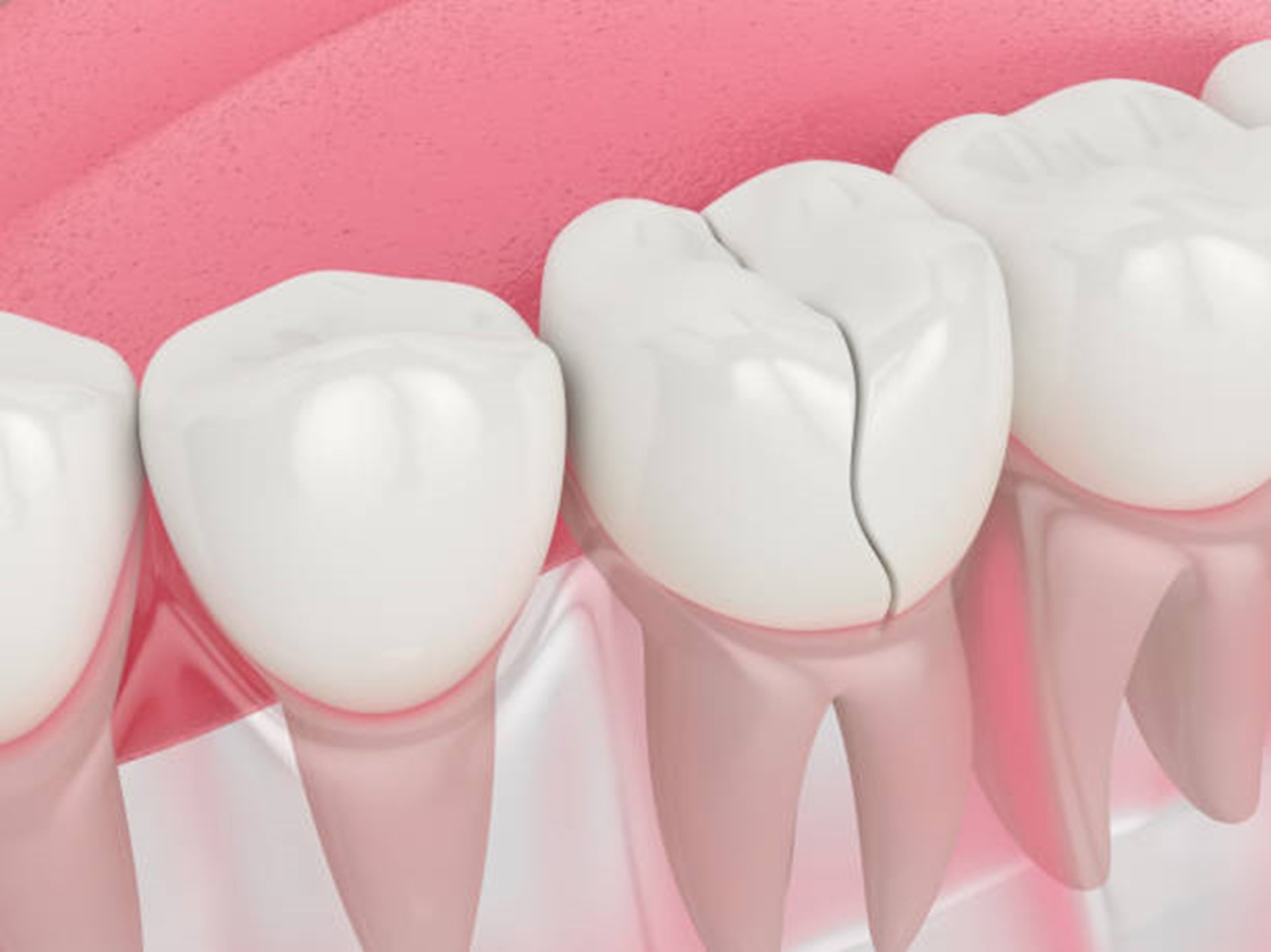 Cracked Tooth Solutions: Exploring Composite Bonding, Veneers, and Crowns at Dental Concepts