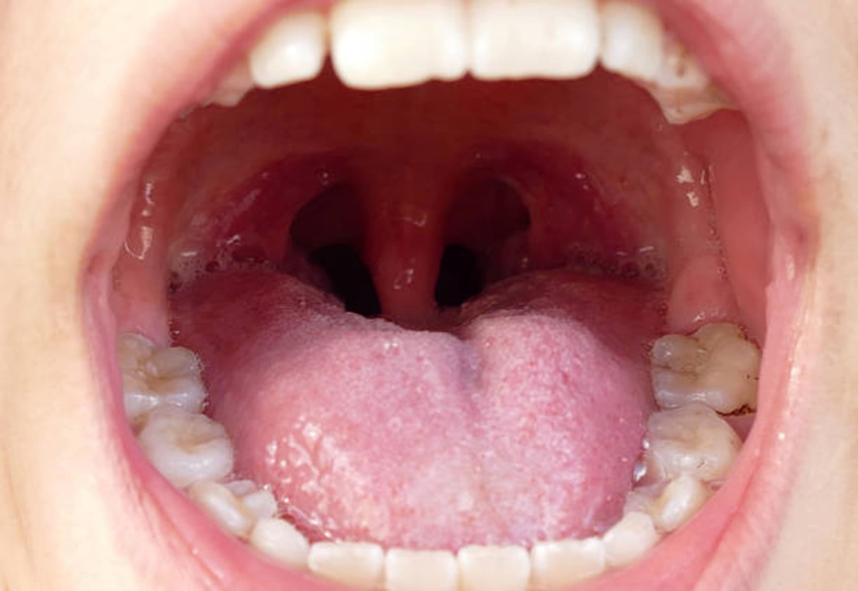 Understanding Tonsil Stones: Causes, Symptoms, and Treatment Options with Dental Concepts