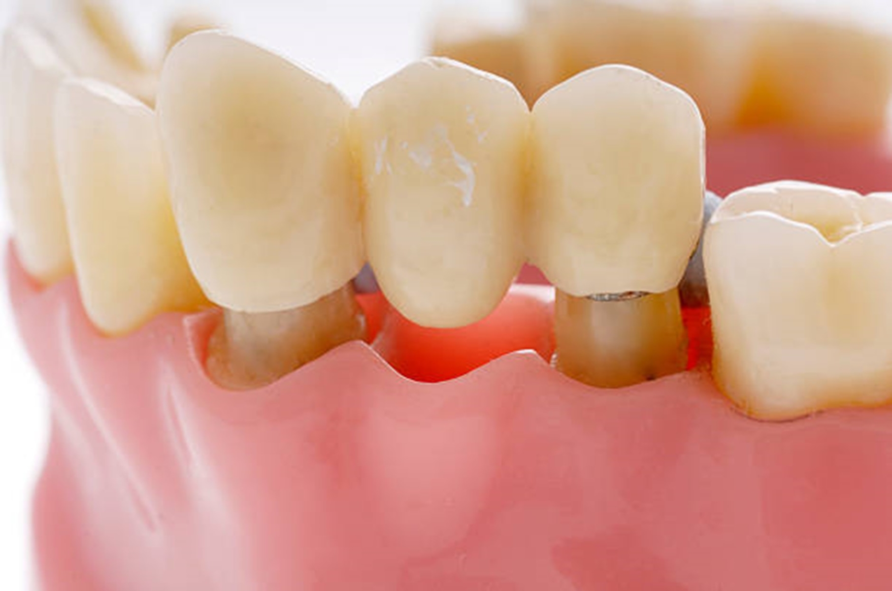 Decoding Dental Bridges: Longevity, Frequency, Pros, and Cons