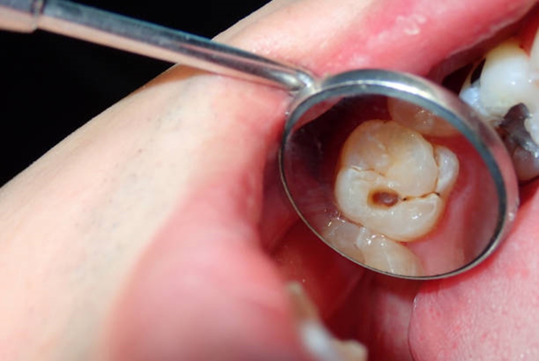 Why Dental Decay Appears Black