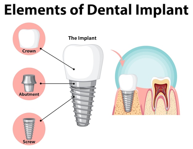5 reasons you should get dental implants