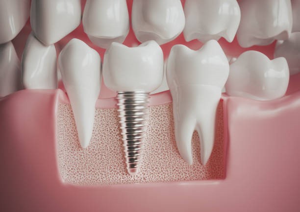 Bone Grafts in Dental Implants