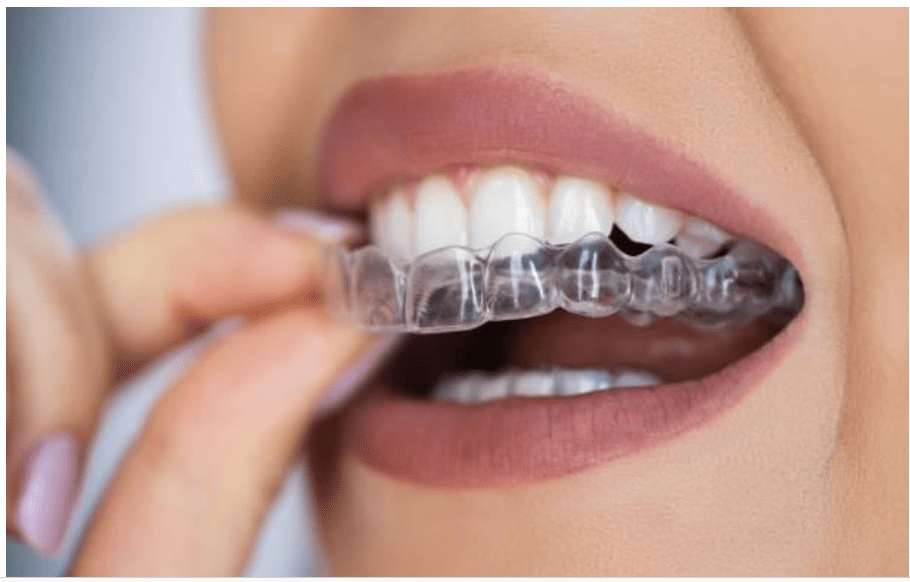 Invisalign Aftercare Tips: With Dental Concepts