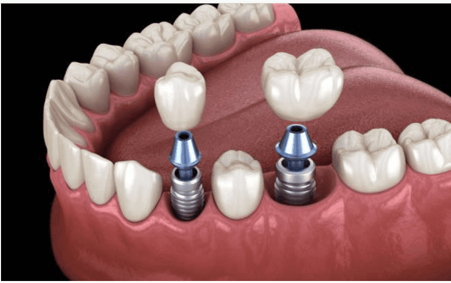 Keyhole Dental Implant Surgery: A Leap Forward in Tooth Replacement