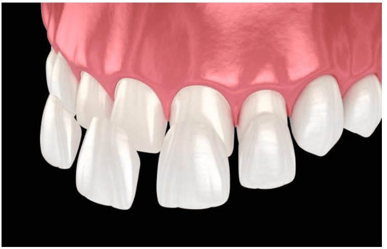 The Dangers of Overpreparation and the Need for Conservative Cosmetic Dentistry