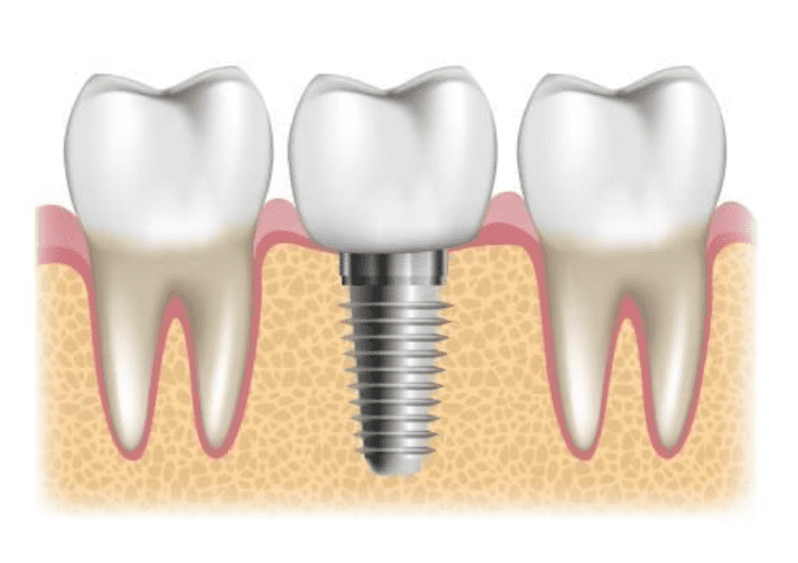 The Healing Journey of Dental Implants: Why Patience is Key	