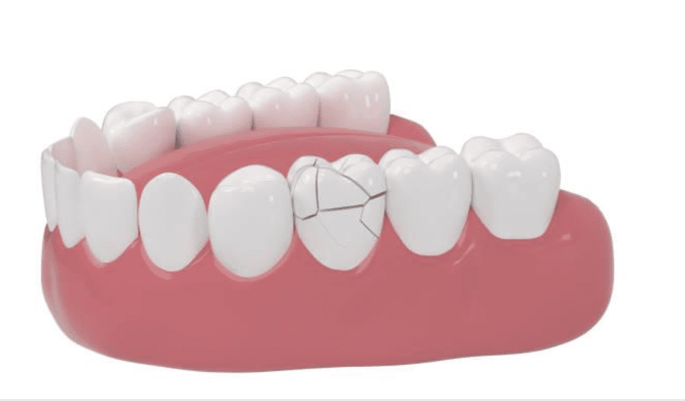 Your Options for Broken Teeth: How Dental Concepts Can Help