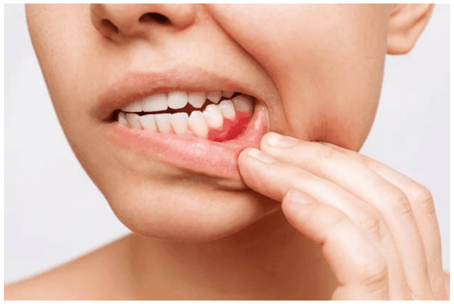 Can Food Get Under Gums? Gum Health and Dental Hygiene Explained