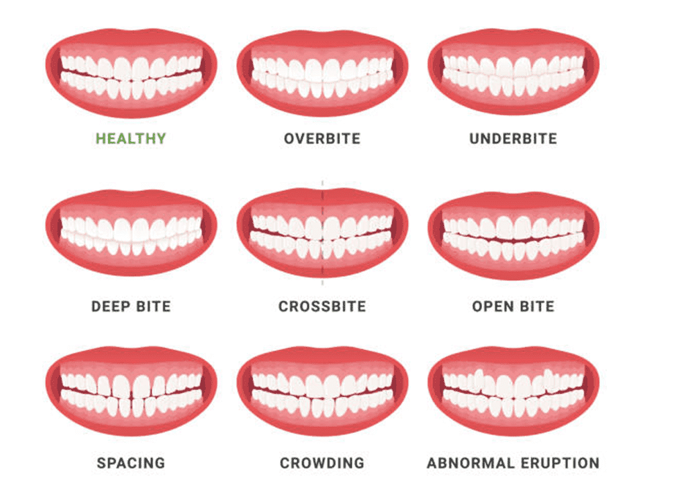 Unlocking a Straighter Smile: How to Fix a Wonky Jaw