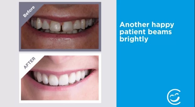 Teeth transformed with a smile makeover: a case study