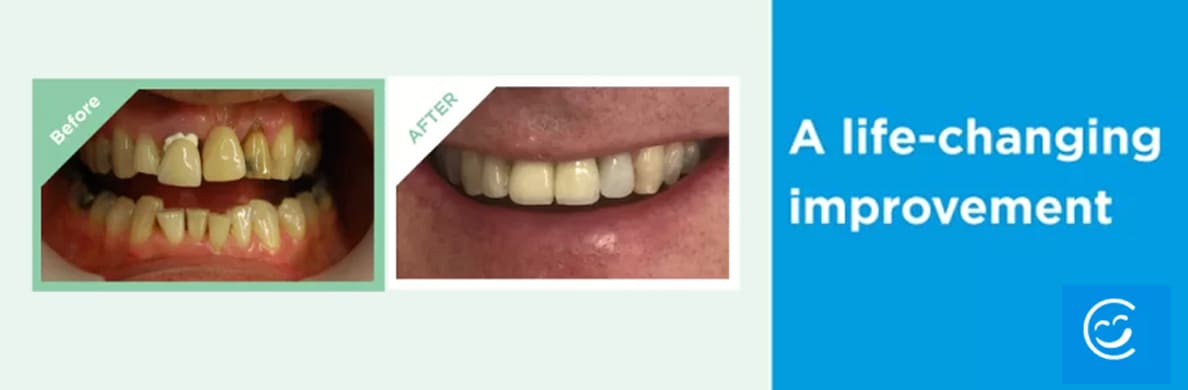 New teeth with dental implants: a case study