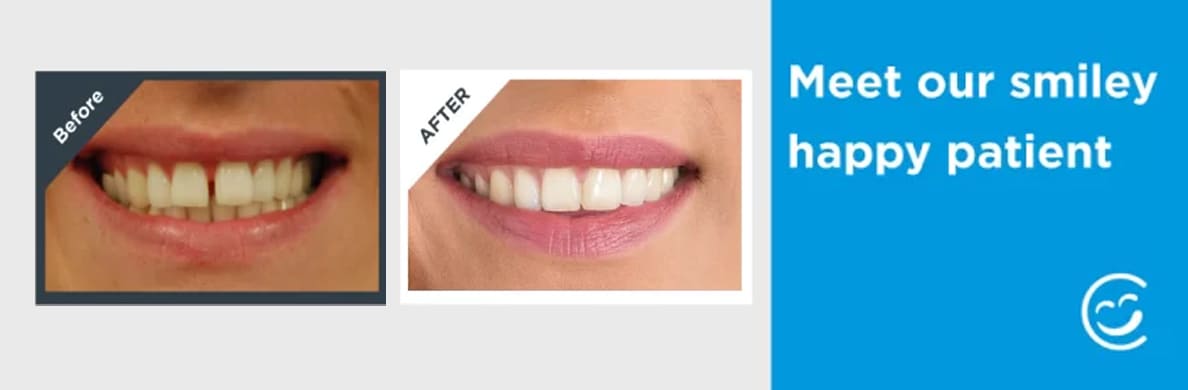 Straighter teeth: a case study