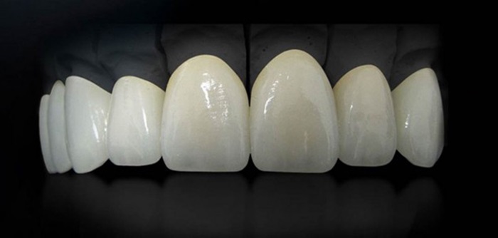 Why Would You Need To Change Your Porcelain Veneers?