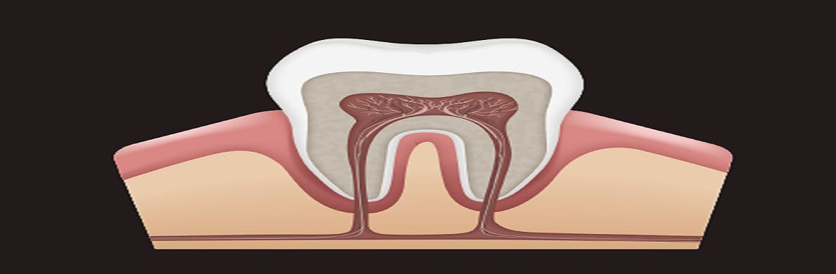 Why do root canals take 2 visits?