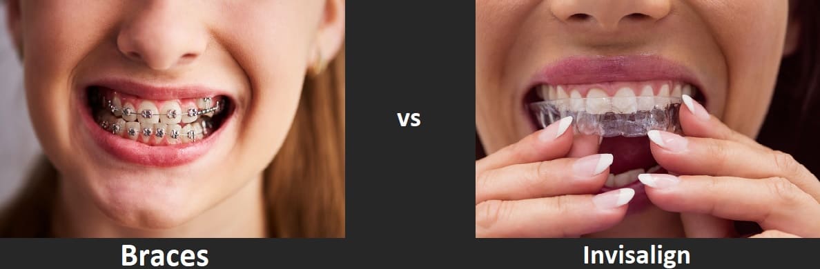 The difference between braces and Invisalign