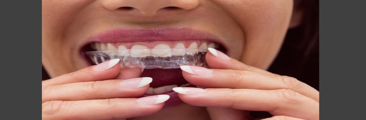 Is Invisalign as good as braces?