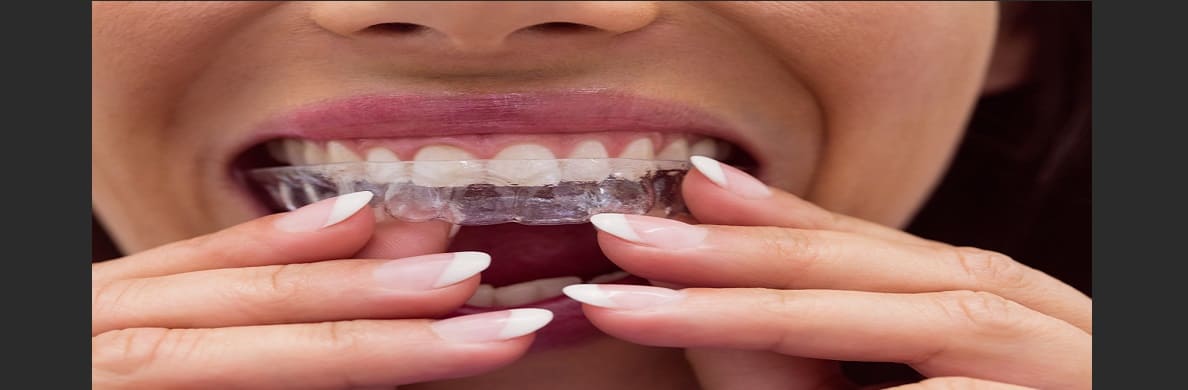 How long does it take to adjust to Invisalign aligners?