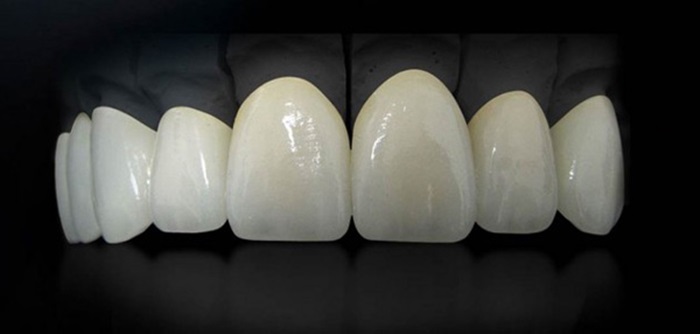 Are porcelain veneers a good idea