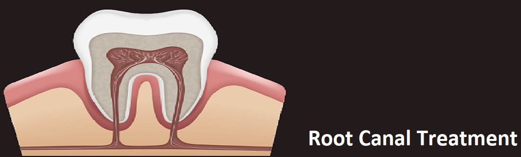 Things you need to know about Root Canal Treatment
