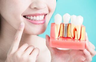 Dental implants - How it works and what to expect.