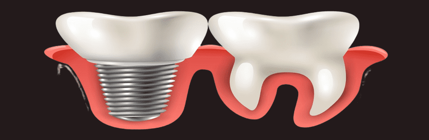 What is the downside to dental implants?